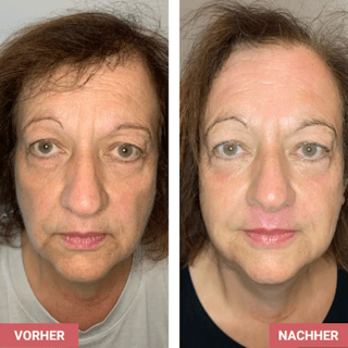 Vorher / Nachher