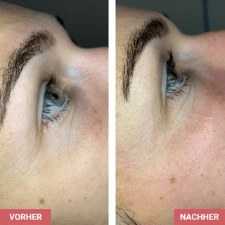 Vorher / Nachher