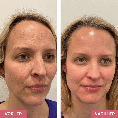 Vorher / Nachher