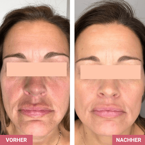 Vorher / Nachher