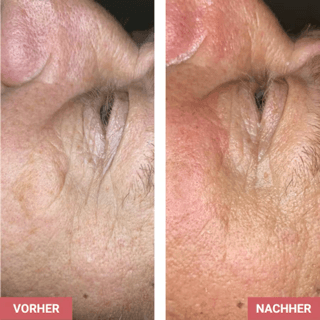 Vorher / Nachher