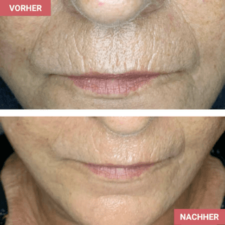 Vorher / Nachher